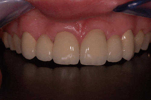appearance of bridges after cosmetic dentistry
